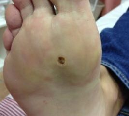 Modi per rimuovere la verruca sulla suola delle gambe