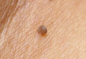 Quadro clinico del papilloma