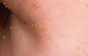 Le ragioni dell'apparizione dei papillomi sul corpo