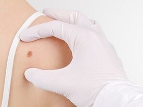 Qual è il pericolo di avere papillomi sul corpo