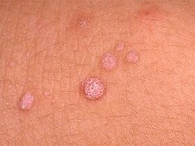 come sbarazzarsi dei papillomi sul corpo