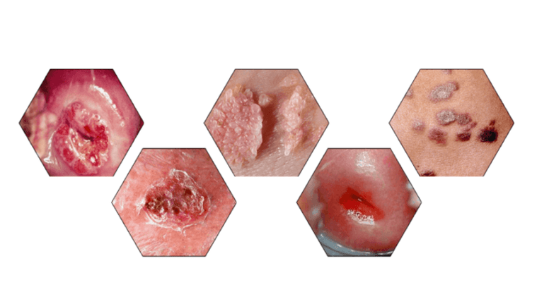 Perché i papillomi sono pericolosi