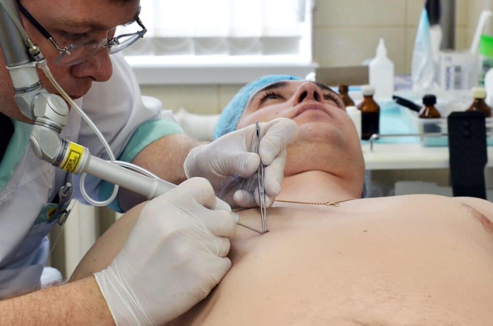 come sbarazzarsi delle verruche sul corpo