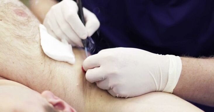 metodi professionali per rimuovere papillomi sul corpo umano