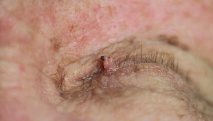 papilloma sulla palpebra come liberarsene