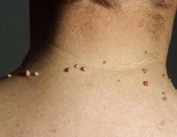Papillomi sul collo di un uomo