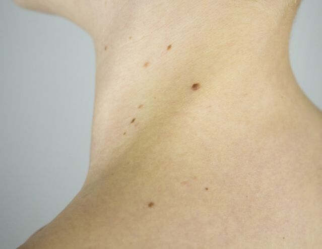 Papillomi sul collo di una ragazza