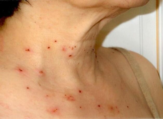 Risultati del trattamento dei papillomi sul collo