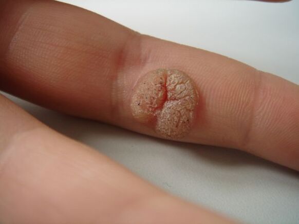 Complicazione dell'autorimozione del papilloma