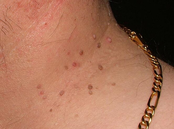 Papillomi sul collo