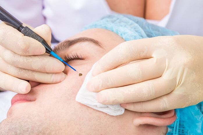 rimozione del papilloma sul viso a causa del papillomavirus umano