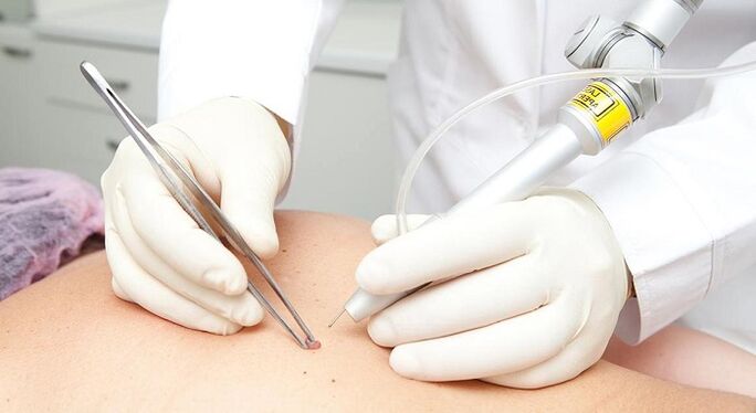 rimozione laser del papilloma per papillomavirus